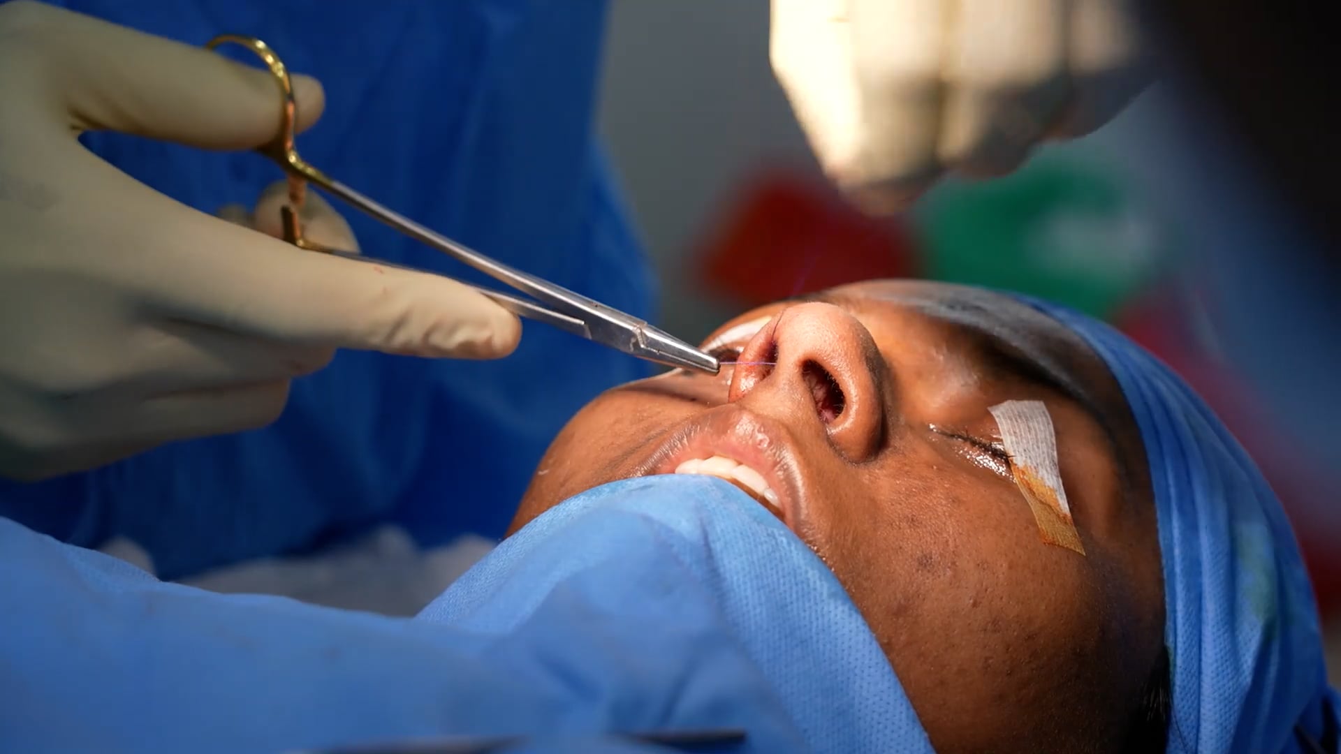 Rhinoplasty
